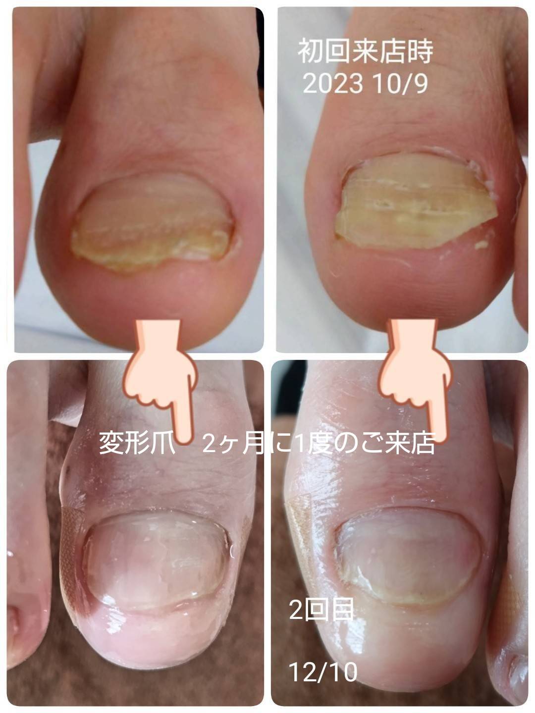 変形爪